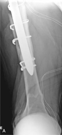 Fig. 107.6, Periprosthetic femoral fracture type C, distal to a long femoral stem treated with plate-cable system osteosynthesis. (A) Anteroposterior (AP) view of the distal femur. (B) Lateral view of the distal femur. (C) AP view, 6 weeks postoperatively. (D) Lateral view, 6 weeks postoperatively.