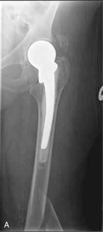 Fig. 107.7, In type D, the fracture has divided a femur that supports 2 implants: hip hemiarthroplasty and a knee replacement. (A) Type C fracture for hip hemiarthroplasty. (B) Type C fracture for total knee replacement.