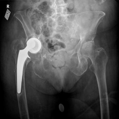 Fig. 107.8, In type E, the fractures involve 2 bones that support 1 joint replacement, such as both the acetabulum and femur after hip replacement.