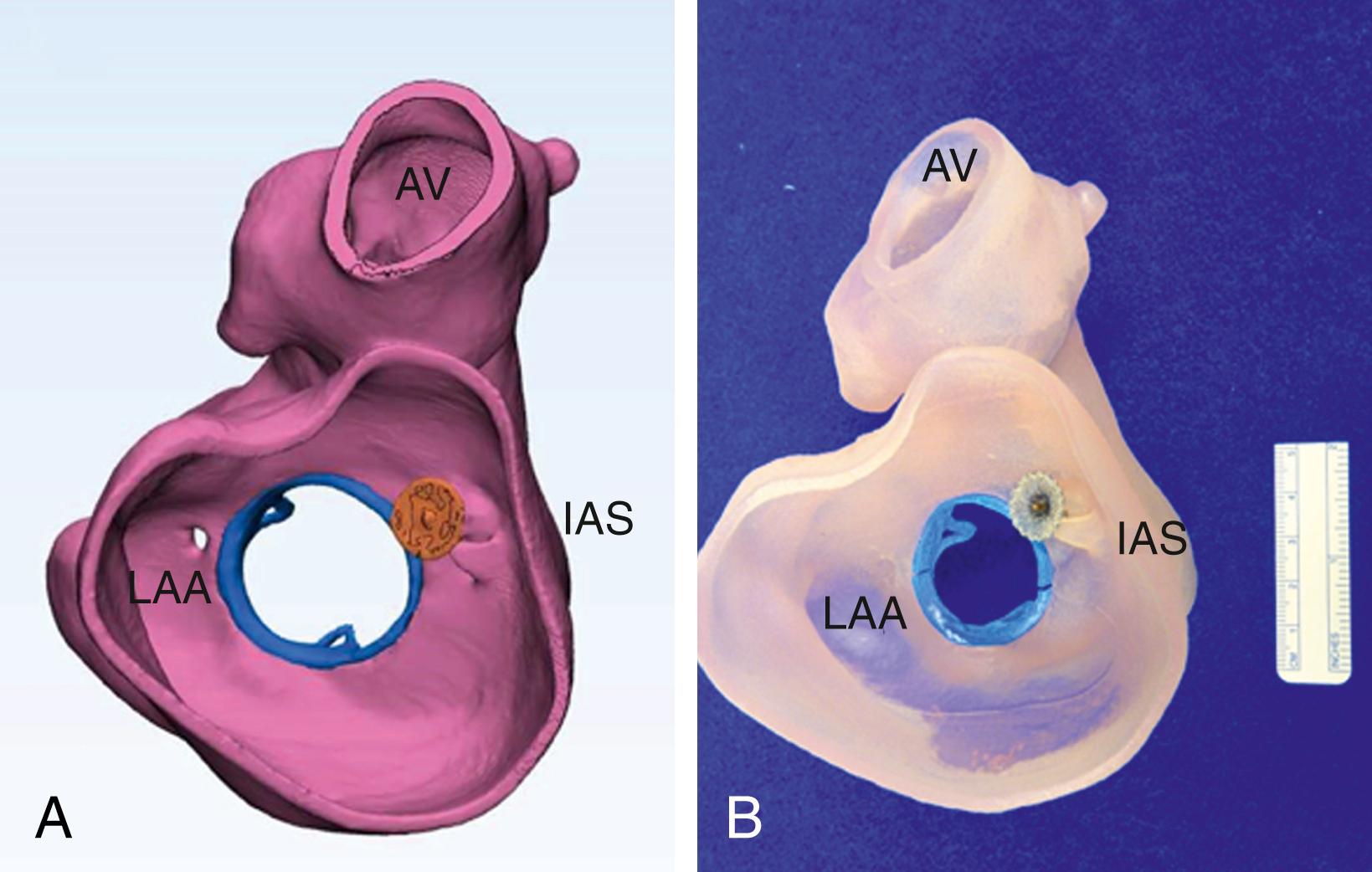 Figure 172.1, Use of three-dimensional (3D) printing for predicting size of paravalvular regurgitation (PVR) closure device and its interaction with the prosthetic valve after deployment. A, A patient-specific digital model designed using multidetector computed tomography images. B, A 3D-printed model showing a closure device deployed in an anteromedial PVR. Aortic valve; IAS, interatrial septum; LAA, left atrial appendage.