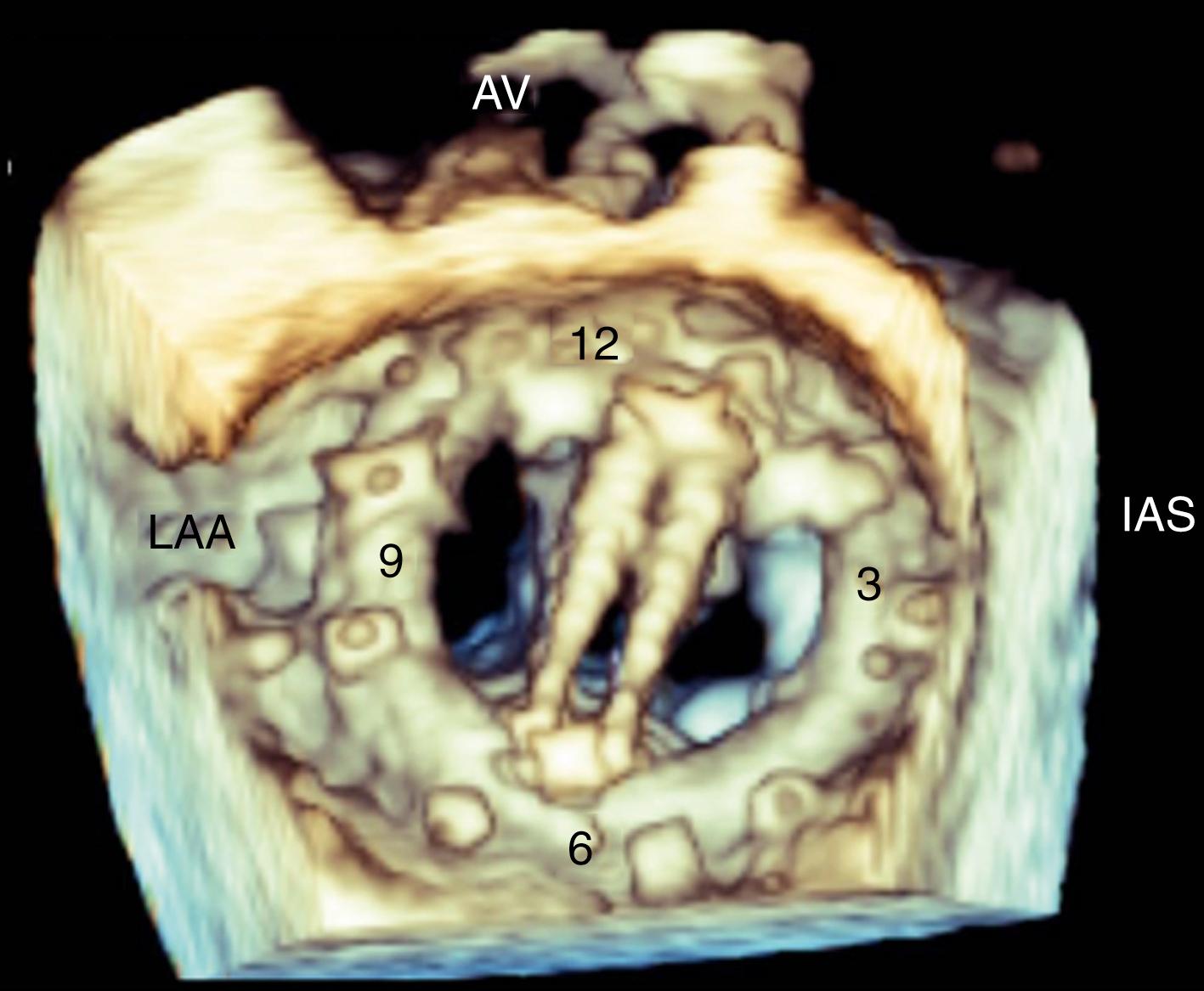 Figure 172.2, Three-dimensional en face surgical view of the mitral valve. The aortic valve (AV) marks the anterior border at 12 o’clock, the left atrial appendage (LAA) marks the lateral border at 9 o’clock, the interatrial septum (IAS) marks the medial border at 3 o’clock, and the posterior atrial wall marks the posterior border of the mitral prosthetic valve at 6 o’clock. The landmarks facilitate communication with the interventional cardiologists.