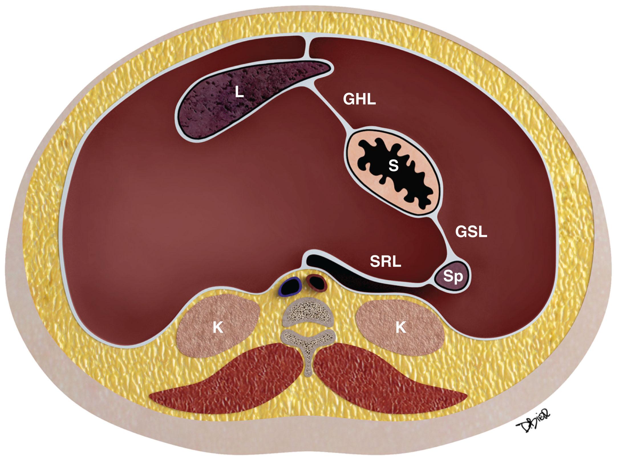 Figure 33.1, Embryologic rotation of the peritoneal structures to the eventual adult position. The liver (L) will grow and fill the right side of the peritoneal cavity. The spleen (Sp) moves similarly to the left. GHL , Gastrohepatic ligament; GSL , gastrosplenic ligament; K , kidney; S , stomach; SRL , splenorenal ligament.