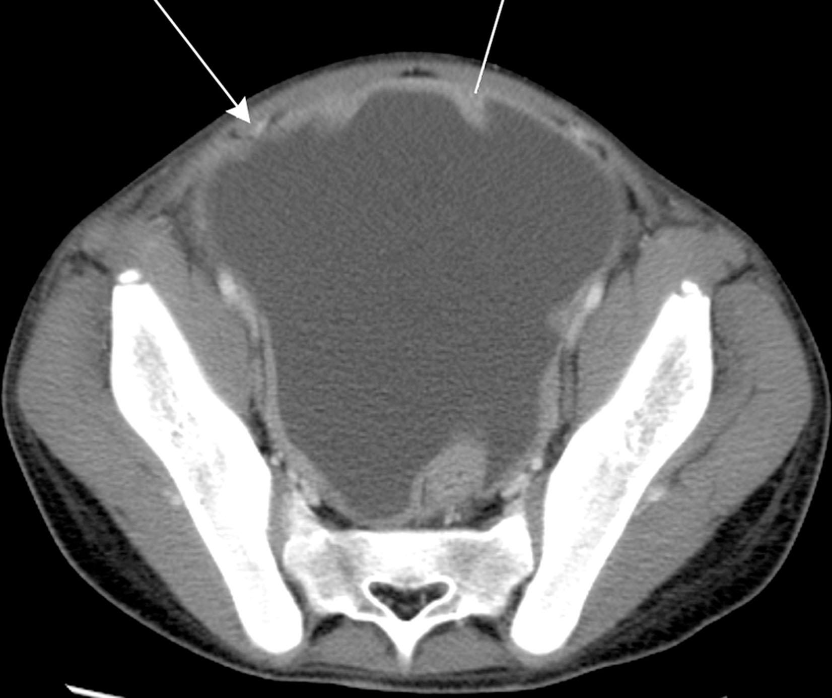 Figure 33.11, Computed tomography with intravenous contrast. Ascites in a 13-year-old with rhabdomyosarcoma. Ascites fill the pelvis, optimizing visualization of the anterior paravesicular spaces. The lateral and medial inguinal fossae are separated by the lateral umbilical fold (landmarked by the inferior epigastric vessels [ arrow ]). The supravesicular space lies in between the medial umbilical fold, which is the site of the obliterated umbilical vein ( line ).