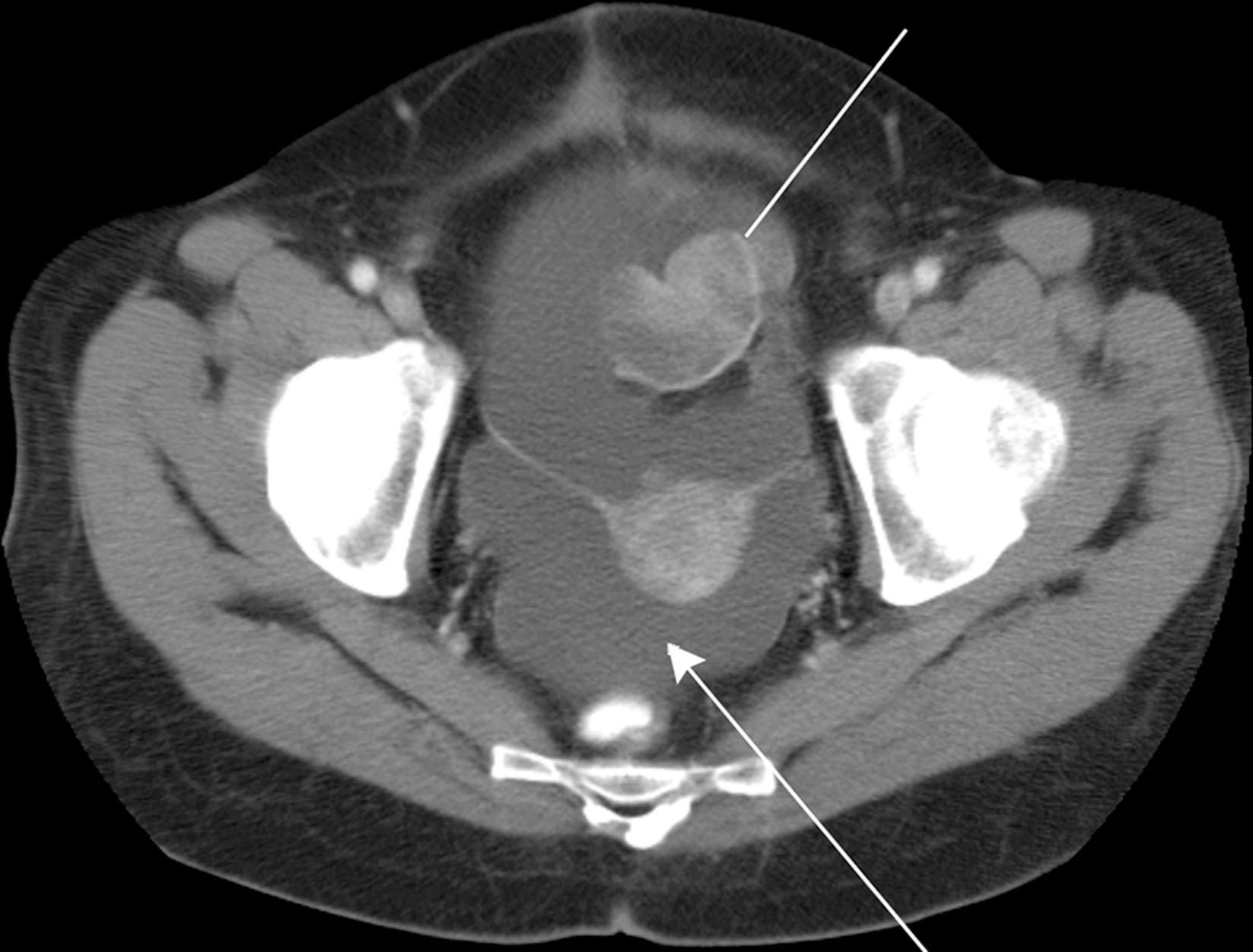 Figure 33.12, Computed tomography with intravenous contrast. A 52-year-old woman with spindle cell sarcoma with metastasis to the peritoneum. Ascites reveal the large potential space in the rectouterine space ( arrow ). Note the large enhancing metastatic deposit in the supravesicular space ( line ).