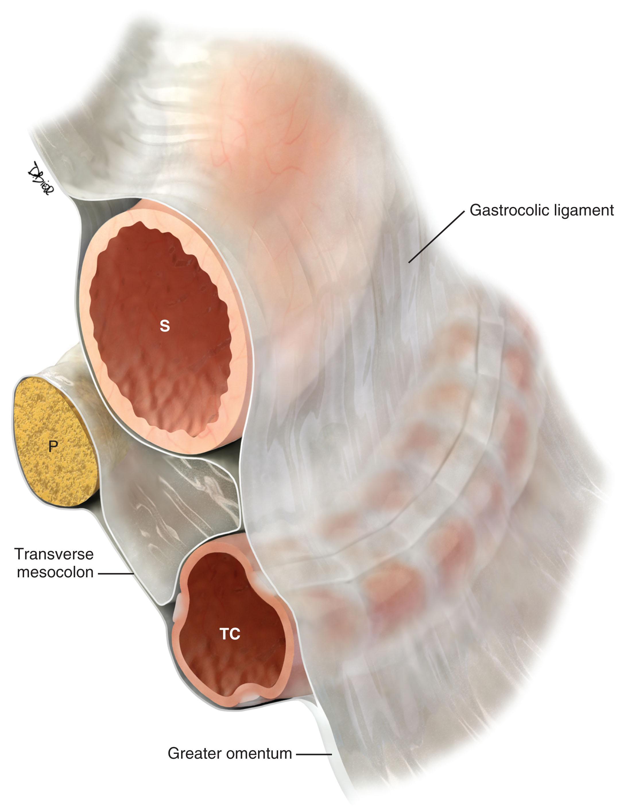 Figure 33.4, The peritoneal structures in oblique view. Diagrammatic representation and relationship of the stomach ( S ), pancreas ( P ), and transverse colon ( TC ) and their attachments.