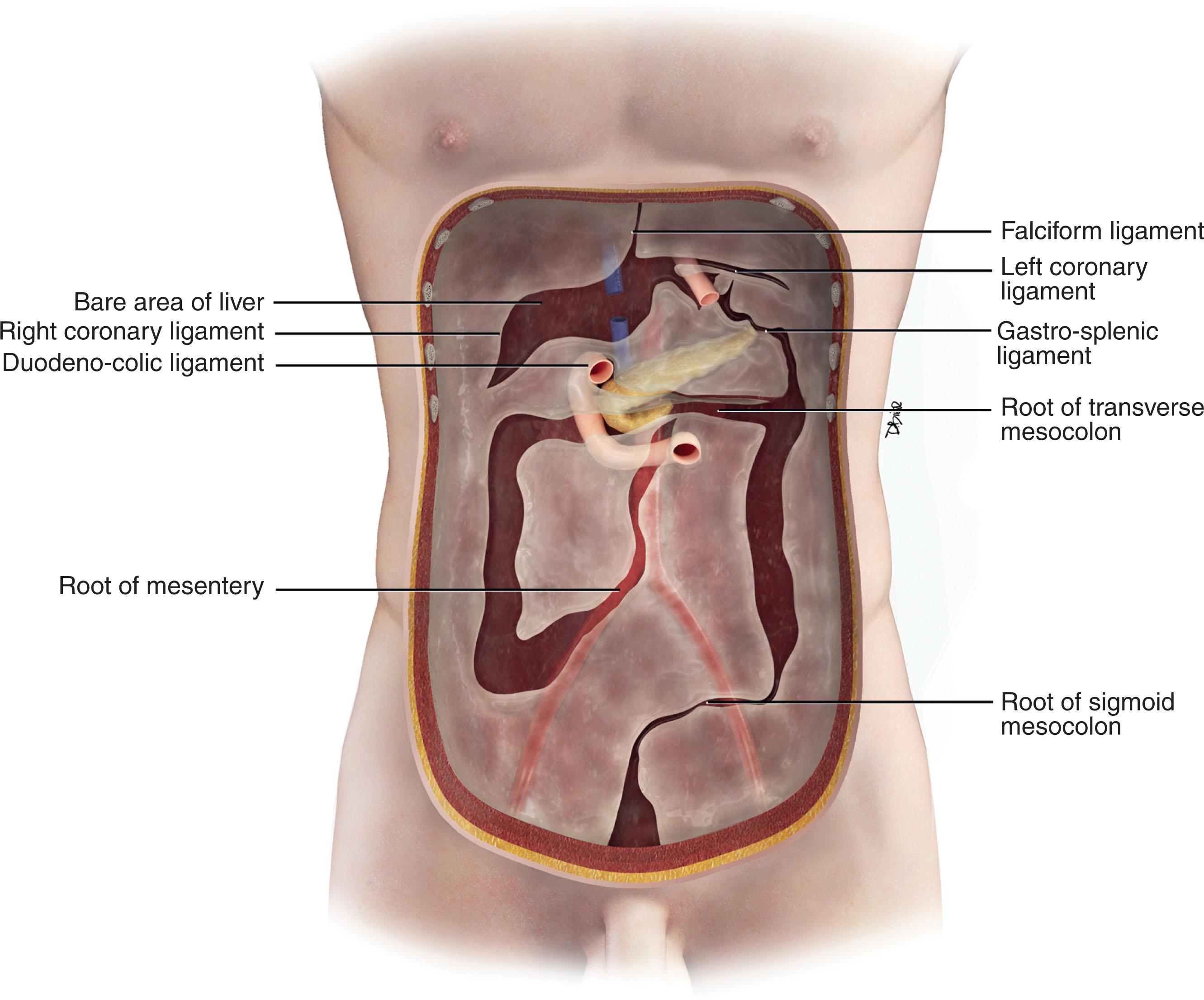 Figure 33.5, A and B , Coronal view of the peritoneal spaces and attachments, including the supramesocolic and inframesocolic spaces. Note that there is no communication between the left supramesocolic and the left paracolic spaces, owing to the phrenocolic ligament.