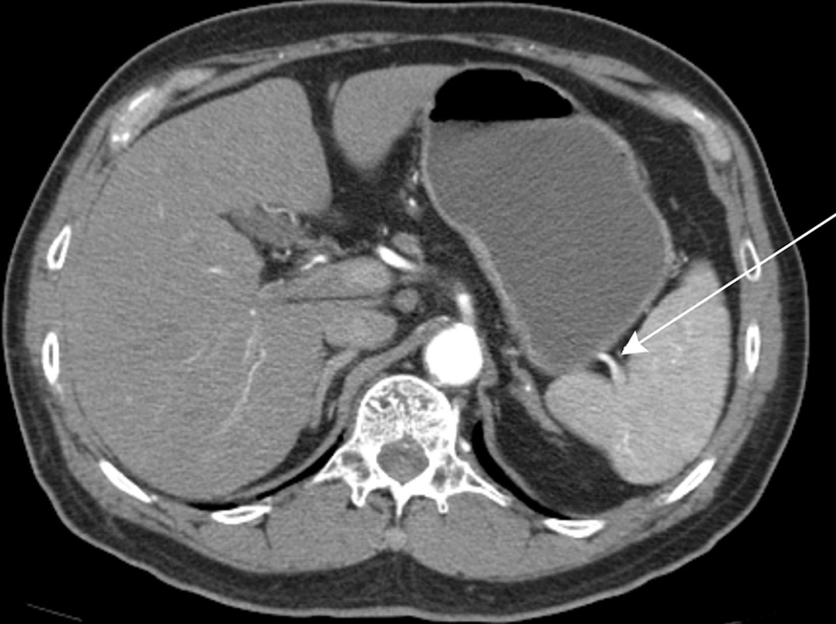 Figure 33.7, Computed tomography with intravenous contrast. The gastrosplenic ligament is delineated by the short gastric artery ( arrow ) and left gastroepiploic vessels (not shown). The gastrosplenic ligament extends from the greater curvature of the fundus and upper body of the stomach to the splenic hilum.