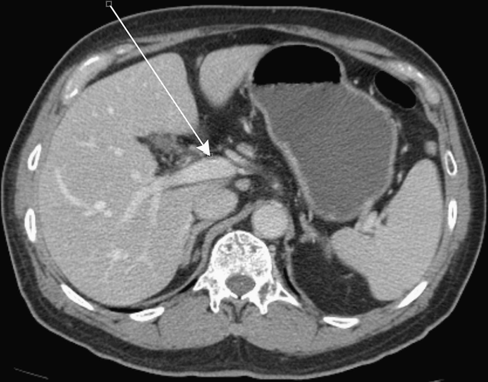 Figure 33.8, Computed tomography with intravenous contrast. The hepatoduodenal ligament contains the portal vein ( arrow ), hepatic artery, extrahepatic bile duct, and nodal stations. It connects the lesser curvature of the stomach to the hepatic hilum.