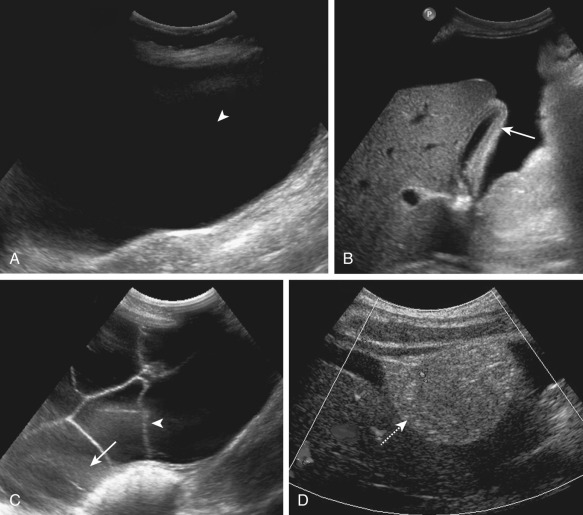 Figure 81-1, Ultrasound images of simple and “complicated” ascites. A and B, A 44-year-old man presented with alcoholic cirrhosis. Peritoneal fluid (arrowhead, A ) is anechoic without debris, consistent with simple ascites of chronic liver disease. The gallbladder ( arrow, B ) is thickened. C and D, A 54-year-old woman presented with ovarian cancer. The ascites shows septation (arrowhead, C ) and debris ( arrow, C ). A peritoneal mass ( dashed arrow, D ) with vascular flow is seen. These findings are consistent with complicated ascites of peritoneal carcinomatosis.