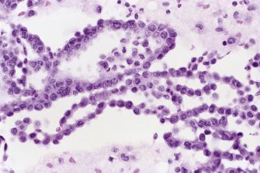 Fig. 5.2, Mesothelial Cells (Cell Block)