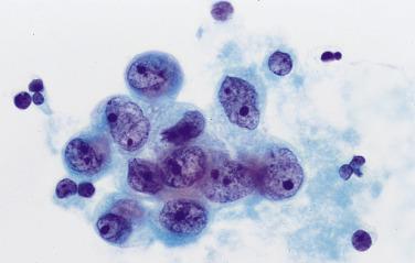 Fig. 5.6, Reactive Mesothelial Cells (Ovarian Torsion)