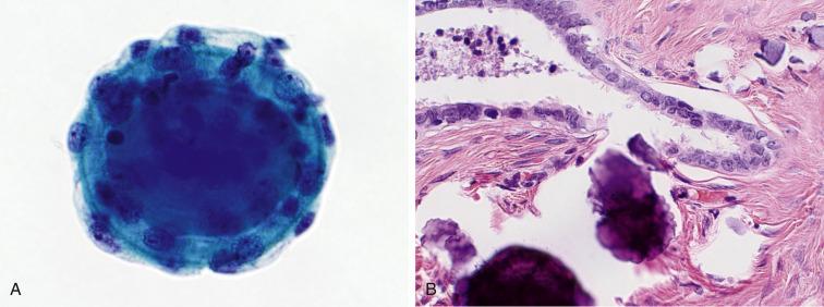 Fig. 5.7, Endosalpingiosis