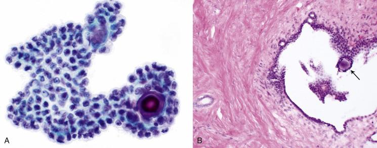 Fig. 5.8, Serous Adenofibroma of the Ovary.