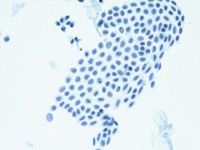 Figure 12-1, Flat sheet of mesothelial cells in mosaic pattern. Peritoneal washing (Papanicolaou, ×MP).