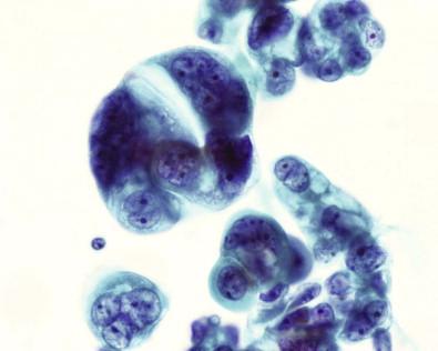 Figure 12-2, Serous papillary carcinoma. Groups and single cells showing anisonucleosis and nucleoli. Pelvic washing (Papanicolaou, ×HP).
