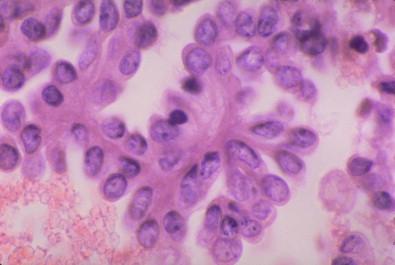 Figure 12-3, Mesothelial hyperplasia. Papillary groups with atypia. Peritoneal cell block washing (H&E, ×HP).