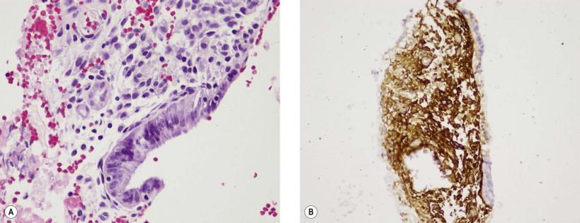 Figure 12-4, Endometriosis. (A) Tissue fragment with stromal cells and glandular cells. Peritoneal cell block washing (H&E, ×MP). (B) Same specimen as 12.4A, with CD10 immunohistochemical stain highlighting endometrial stromal cells. Cell block of pelvic washing (CD10, ×LP).