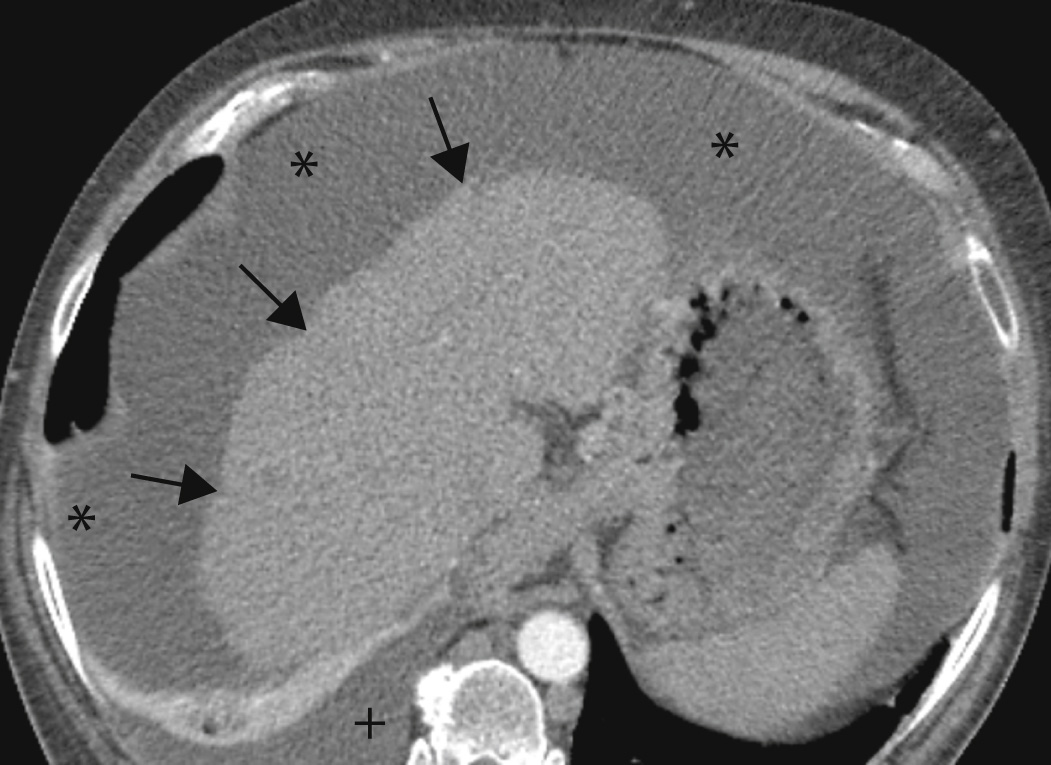 Ascites. The cirrhotic liver has an irregular edge (arrows) and is surrounded by ascites (*). A right pleural effusion with some collapsed lung is also evident (+).