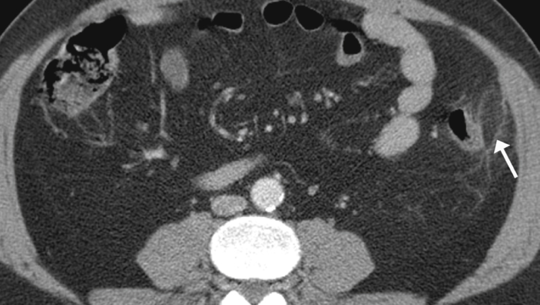 CECT showing an area of increased soft tissue attenuation and stranding of the pericolic fat (adjacent to the descending colon) in keeping with epiploic appendagitis. *