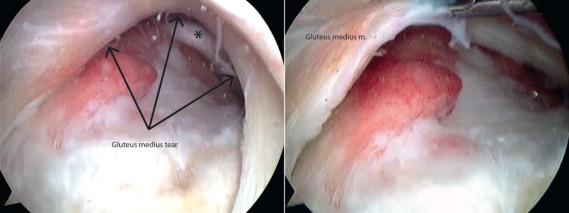 Fig. 83.6, Full-thickness tear of the gluteus medius (left) with the gluteus minimus tendon seen beneath it (asterisk) and gluteus medius tendon mobilized by a tissue grasper (right) .