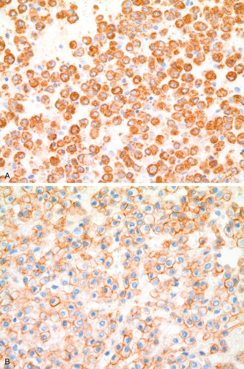 Fig. 24.12, A, Immunostains for actin reveal strong cytoplasmic positivity in glomus cells. B, Immunostains for type IV collagen in glomus tumor show intricate chicken-wire pattern between cells.