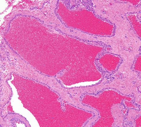 Fig. 24.13, Glomuvenous malformation (glomangioma) with dilated veins surrounded by cuff of glomus cells.