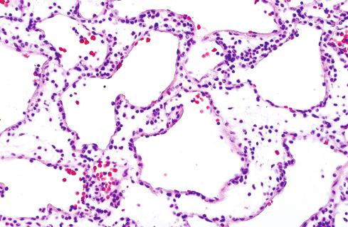 Fig. 24.14, Glomuvenous malformation (glomangioma) with cuffs of cells around dilated vessels.