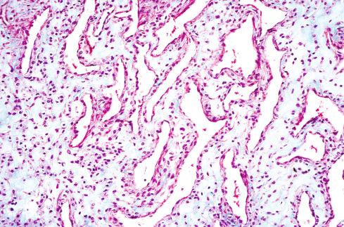 Fig. 24.15, Glomangioma with marked hyalinization (Masson trichrome stain).