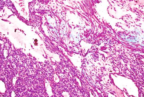 Fig. 24.17, Glomangiomyoma.