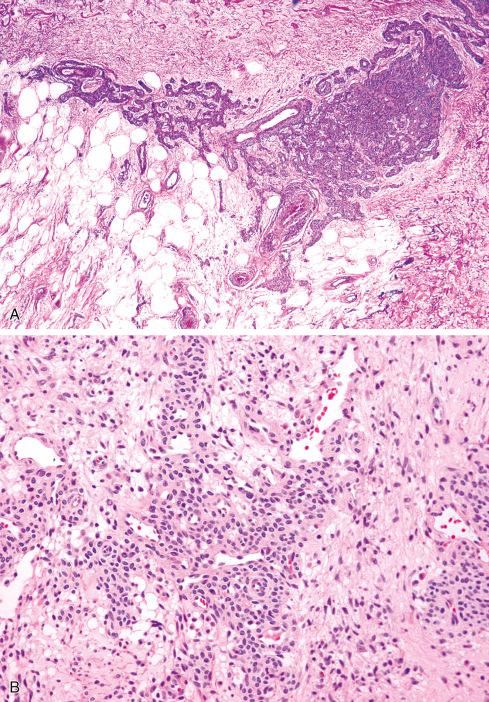 Fig. 24.19, Diffuse glomus tumor (glomangiomatosis) with infiltrative growth of vessels ( A ), which are encircled by glomus cells ( B ).