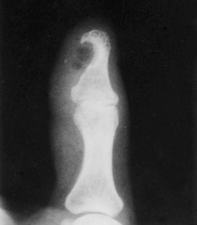 Fig. 24.5, Postoperative radiograph showing defect in distal phalanx created by subungual glomus tumor.