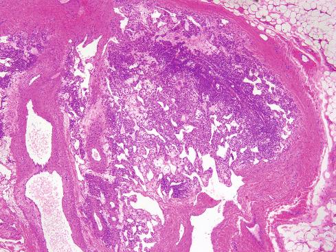 Fig. 24.6, Typical glomus tumor, consisting of well-circumscribed proliferation of uniform round cells, surrounding numerous blood vessels of varying caliber.