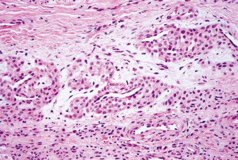 Fig. 24.10, Proliferation of glomus cells in vessels at periphery of glomus tumor. This feature may be helpful for distinguishing solid glomus tumors from adnexal tumors.