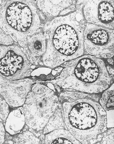 Fig. 24.11, Electron Micrograph of Glomus Tumor.