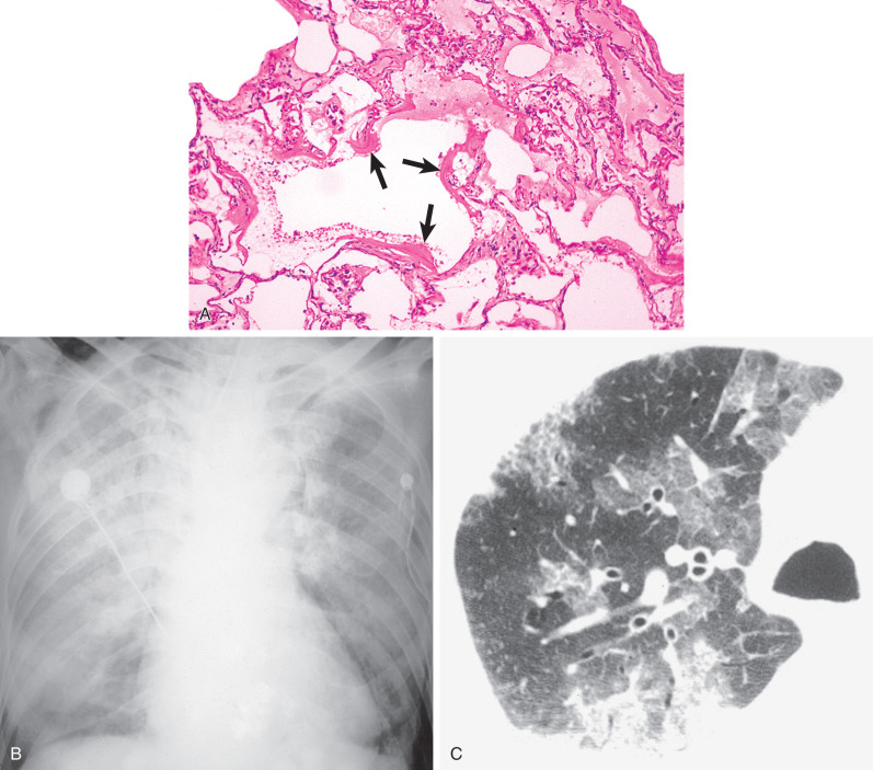 Fig. 55.1, Acute exudative phase of diffuse alveolar damage caused by sepsis. (A) Pathologic specimen shows characteristic intraalveolar hyaline membranes (arrows) and exudates. (B) Chest radiograph shows extensive bilateral ground-glass opacities and consolidation. (C) High-resolution CT scan at the level of the right upper lobe shows patchy ground-glass opacities demarcated by secondary lobules and associated with dependent consolidation.