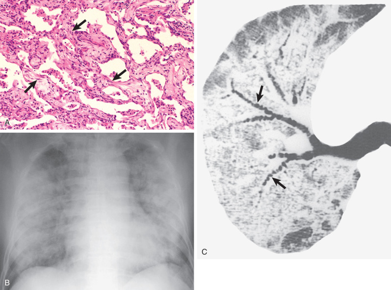 Fig. 55.2, Subacute proliferative phase of diffuse alveolar damage caused by viral pneumonia (3–7 days after the onset of lung injury). (A) Pathologic specimen shows diffuse fibroblastic proliferation (arrows) within the interstitium associated with organized hyaline membranes. (B) Chest radiograph demonstrates bilateral ground-glass opacities, consolidation, and low lung volumes. (C) High-resolution CT scan at the level of the right upper lobe bronchus shows extensive ground-glass opacities with associated reticulation and traction bronchiectasis (arrows).
