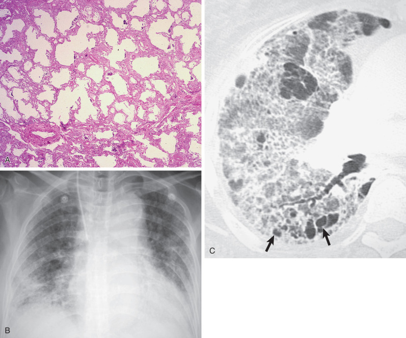 Fig. 55.3, Chronic fibrotic phase of diffuse alveolar damage from acute interstitial pneumonia (2 weeks after the onset of lung injury). (A) Pathologic specimen shows dilated alveolar spaces and architectural distortion caused by interstitial collagen deposition. (B) Chest radiograph shows low lung volumes with bilateral middle and lower lung zone–predominant ground-glass opacities and coarse reticulation. (C) High-resolution CT scan at the level of the right middle lobe shows extensive ground-glass opacities associated with reticulation (crazy paving pattern), traction bronchiectasis, and cystic changes (arrows).