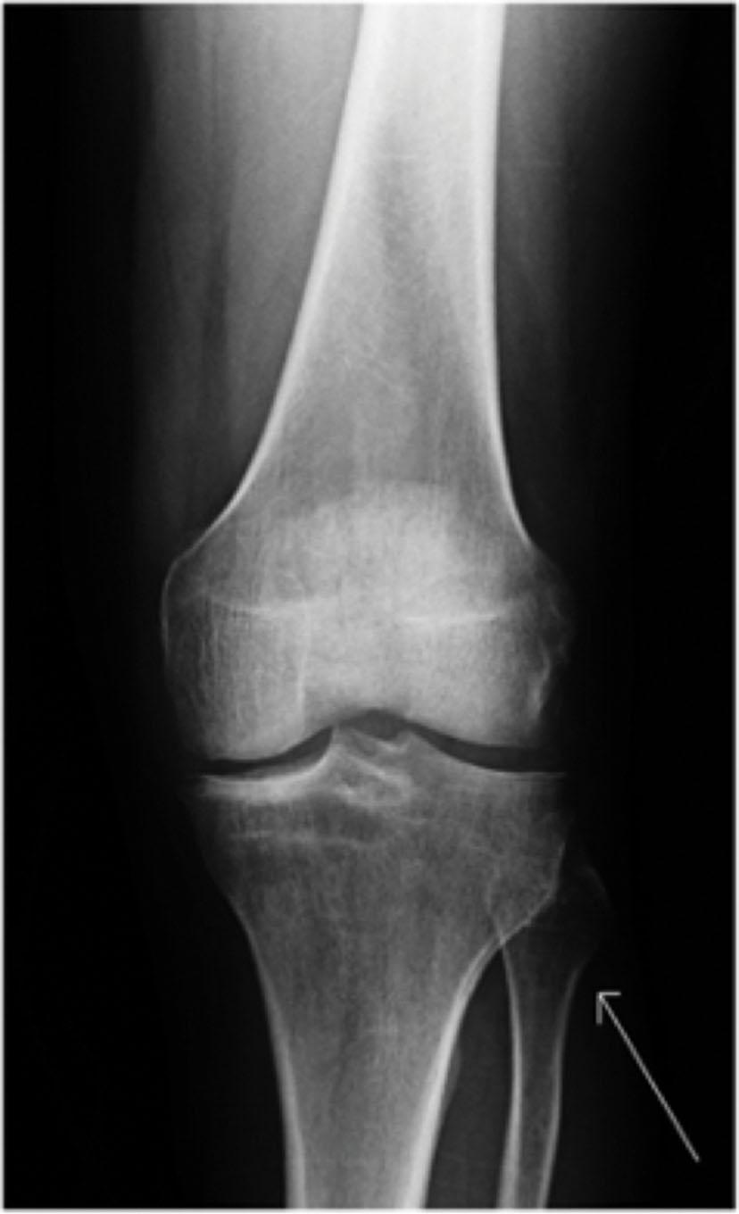 Figure 27.3, Arrow shows the fluoroscopic landmark for a common peroneal nerve compression site at the fibular head.