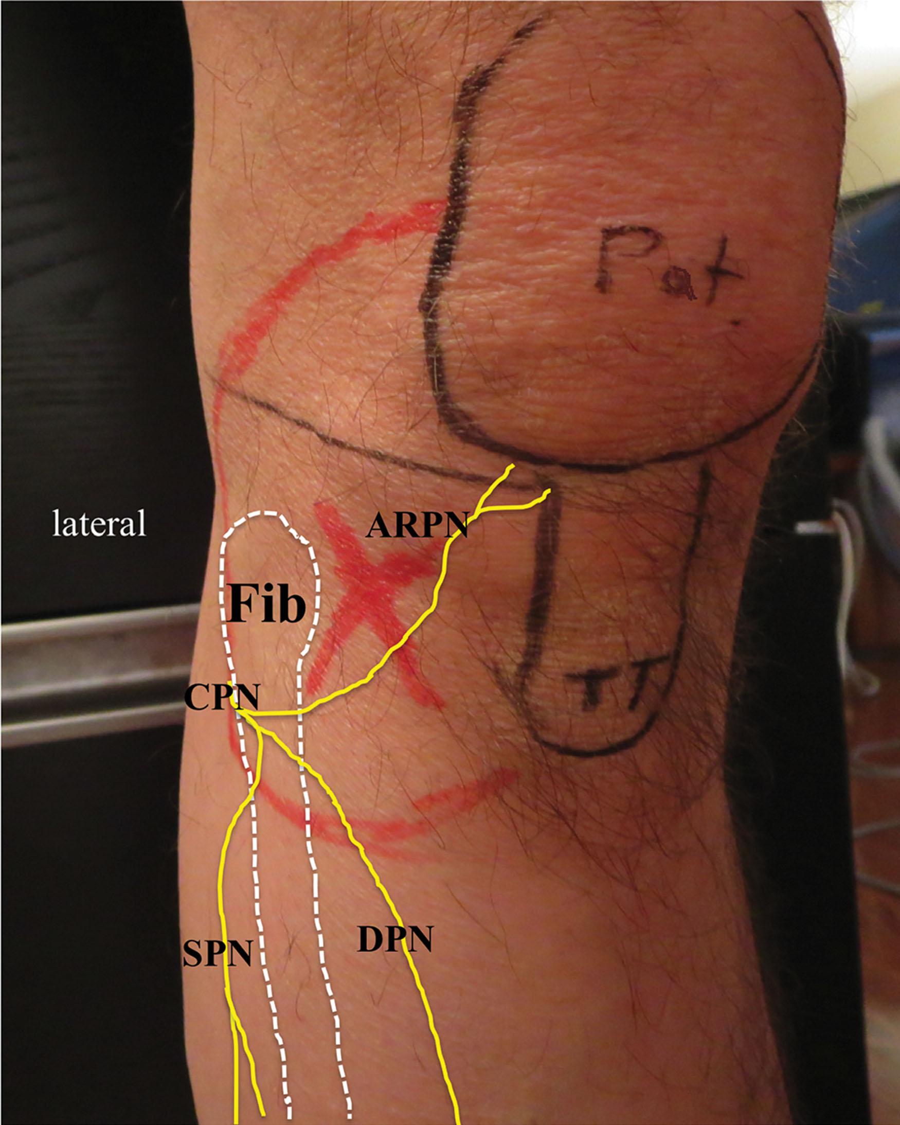 Figure 27.8, Pain pattern of a patient with presumed anterior recurrent peroneal nerve entrapment. ARPN, Anterior recurrent peroneal nerve; CPN , common peroneal nerve; DPN , deep peroneal nerve; Fib , fibula; Pat , patella; SPN , superficial peroneal nerve; TT , tibial tubercle; X , site of tenderness.