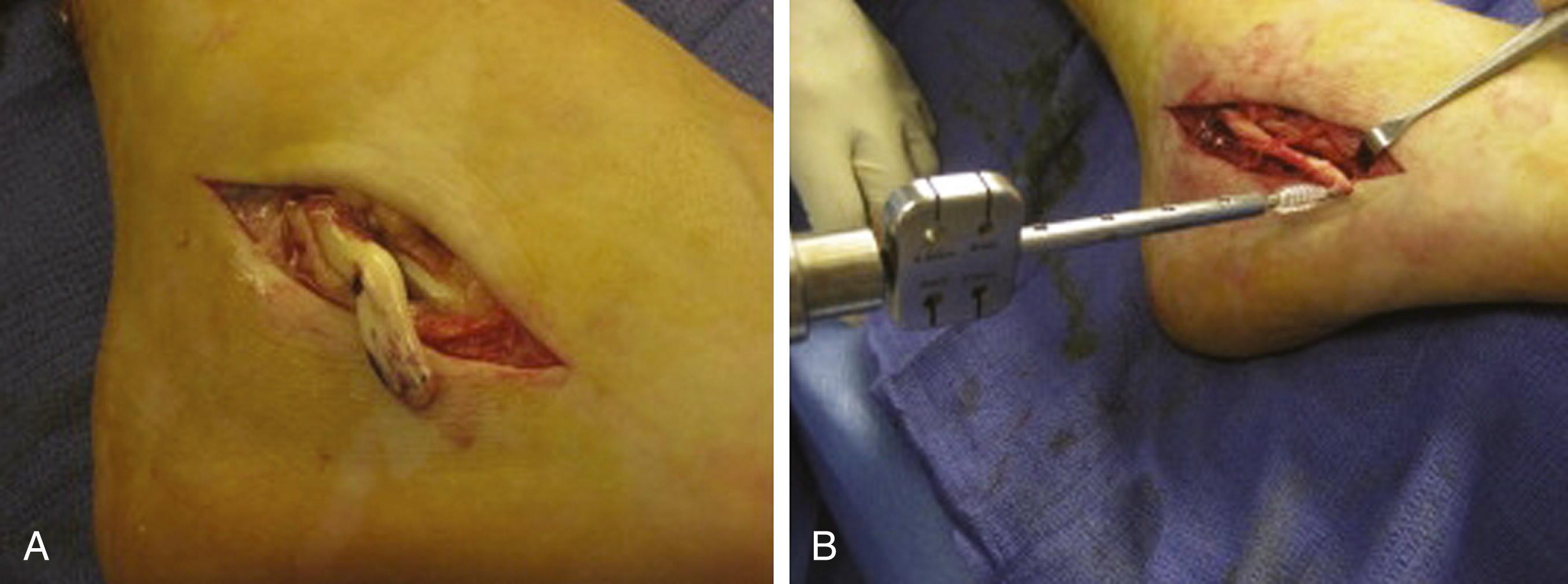 FIG. 188.2, A and B, Photos show complete rupture of the peroneus longus at the cuboid tunnel, which required insertion into the cuboid using an interference screw.