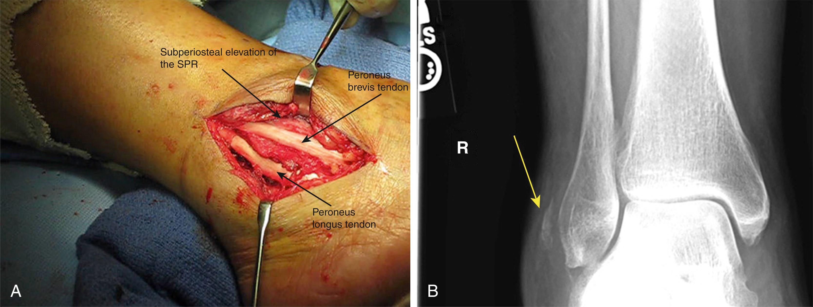 FIG. 188.3, Traumatic peroneal tendon dislocation. (A) Surgical photograph depicting a traumatic dislocation; the superior peroneal retinaculum (SPR) has been disrupted, and the peroneus brevis has dislocated anteriorly out of the retrofibular groove and is lying on the lateral border of the distal fibula. The peroneus longus in this case remained in the retrofibular groove. Close inspection reveals subperiosteal traumatic elevation of the SPR (grade 1). (B) Fleck sign ( yellow arrow ), pathognomonic of an acute Peroneal tendon dislocation, grade 3.