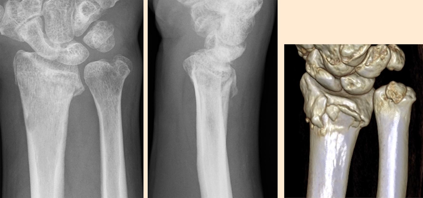 Fig. 2, Preoperative radiographs and CT showed a shortened and dorsally angulated malunion of the distal radius, and an ulnar styloid nonunion.
