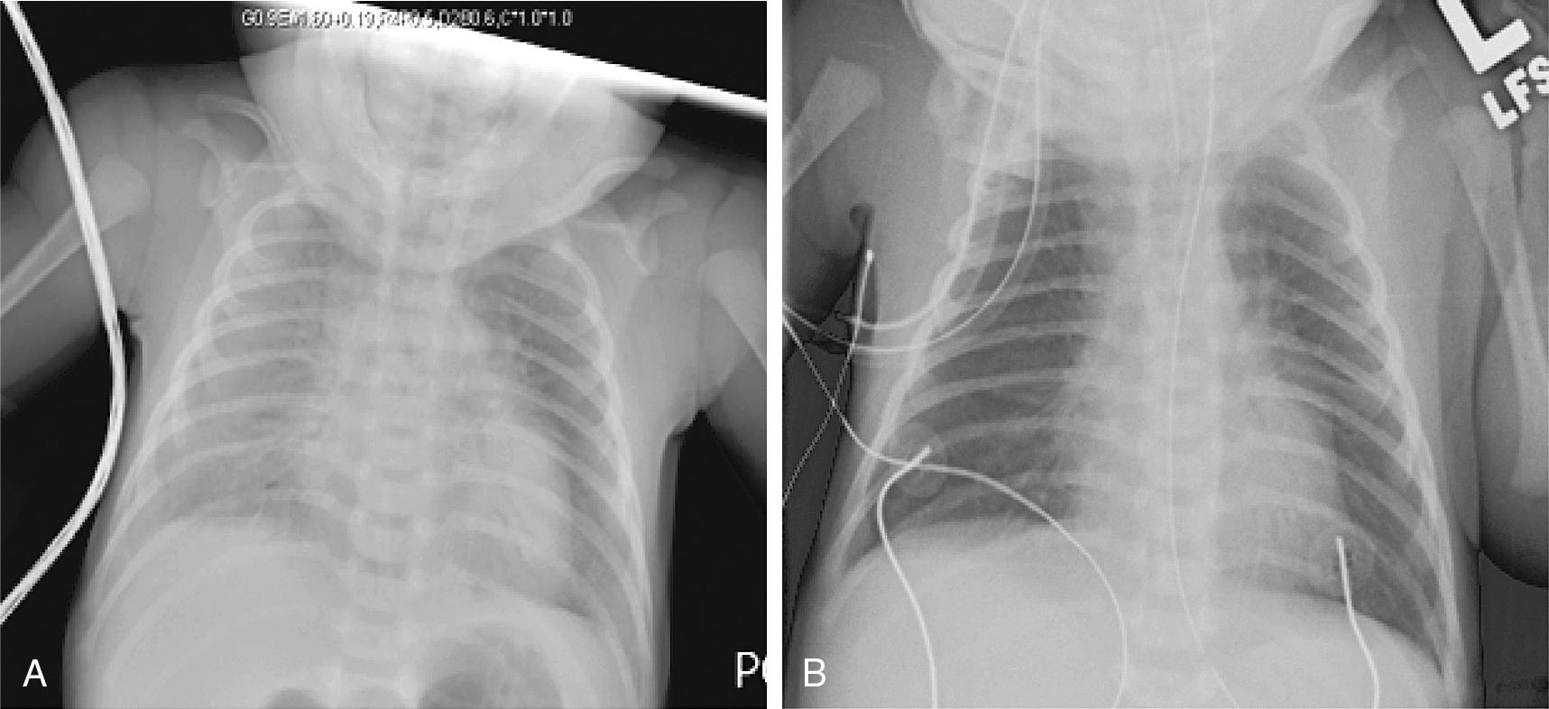 Fig. 17.4, (A) Chest x-ray obtained at approximately 5 hours of life showing 8- to 9-rib expansion with increasing parenchymal densities. (B) Chest x-ray obtained 1 hour after intubation and a dose of surfactant.