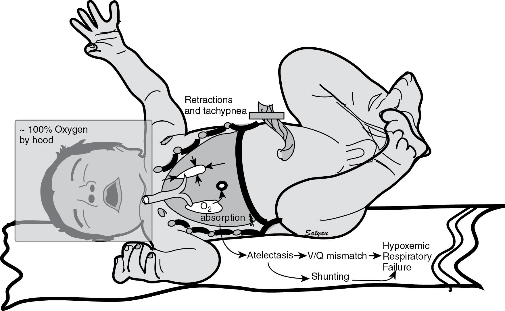 Fig. 17.5, Absorption atelectasis—administration of a high concentration of inspired oxygen without positive pressure in an infant with respiratory distress—can lead to nitrogen washout and alveolar collapse. Atelectasis can result in V/Q mismatch, shunting, and HRF with PPHN.