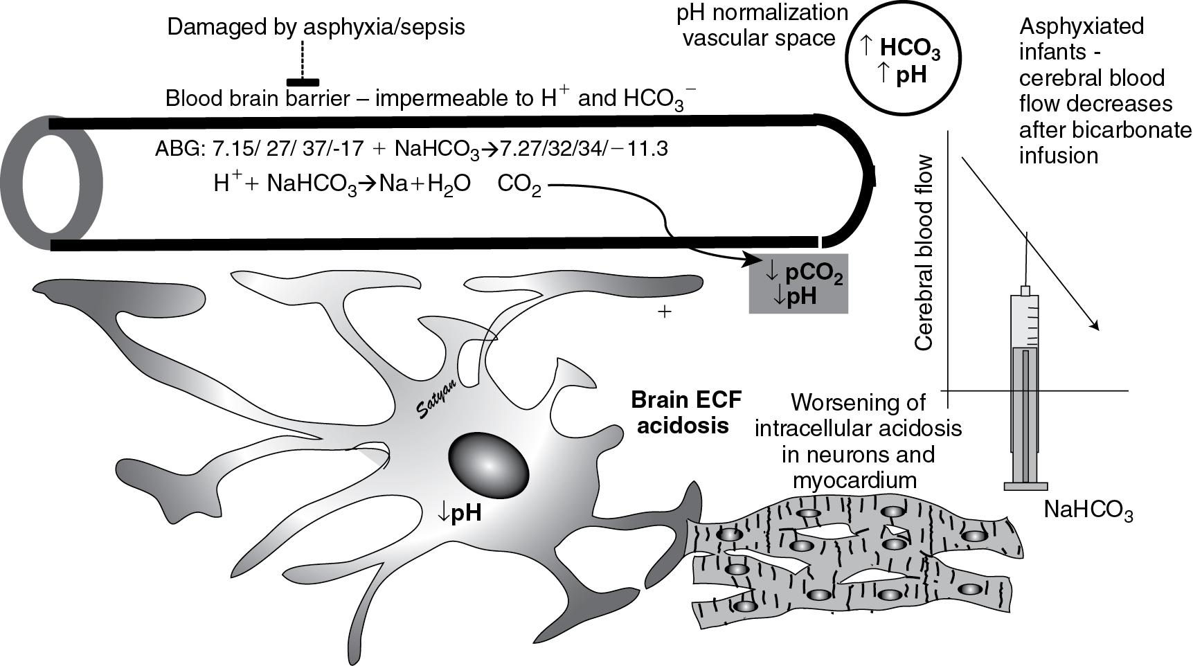 Fig. 17.7, Consequences of rapid infusion of large doses of sodium bicarbonate. The blood–brain barrier is normally impermeable to hydrogen ions and bicarbonate ions. However, CO 2 diffuses easily across the blood–brain barrier into the perivascular space. Acidosis in the perivascular extracellular fluid space in the brain causes cerebral vasodilation, and alkalosis in this space causes cerebral vasoconstriction. In conditions associated with acute metabolic acidosis with compensatory hypocapnia as seen in Case Study 6, low Pa co 2 results in cerebral vasoconstriction. Rapid correction of intravascular acidosis with rapid, large infusions of sodium bicarbonate results in increase in plasma pH, increase in Pa co 2 , and reduction in base deficit. However, increased CO 2 diffuses across the blood–brain barrier, causing perivascular acidosis in the brain. Diffusion of CO 2 also leads to intracellular acidosis in the neuronal cells, glial cells, and cardiac myocytes. In conditions associated with damage to the blood–brain barrier (as in asphyxia, hypoxia, and sepsis/meningitis), sodium bicarbonate may pass through the blood–brain barrier causing acute perivascular alkalosis and reduction in cerebral blood flow ( Lou et al, 1978 ). Hence, caution must be exercised during alkali therapy. If sodium bicarbonate is absolutely needed, only small doses (such as 1–2 mEq/kg) should be infused, slowly and with careful monitoring of acid–base status.