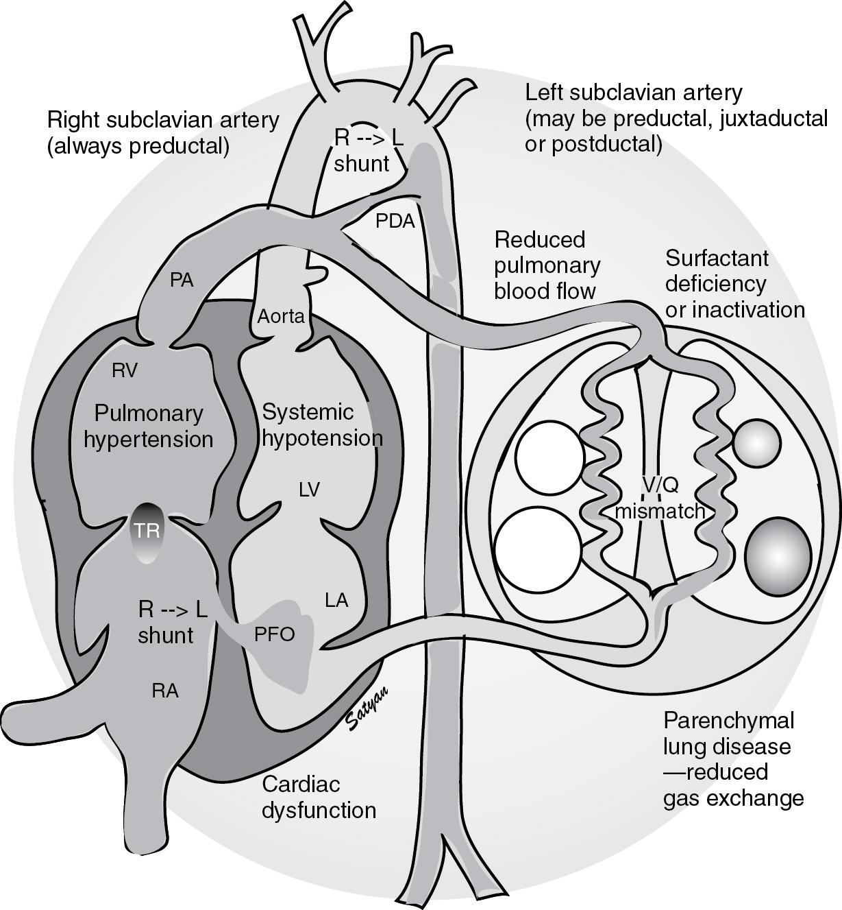 Fig. 17.10, Hemodynamic changes in PPHN/HRF. Surfactant deficiency (RDS) or inactivation (meconium aspiration or pneumonia) result in parenchymal lung disease and ventilation–perfusion (V/Q) mismatch. Increased pulmonary vascular resistance results in reduced pulmonary blood flow and right-to-left shunt through the PDA and/or PFO. Pulmonary hypertension is often associated with systemic hypotension with septal deviation to the left. Cardiac dysfunction secondary to asphyxia, sepsis, or CDH may complicate HRF. The right subclavian artery (and blood flowing to the right upper extremity) is always preductal. The left subclavian artery may be preductal, juxtaductal, or postductal. Hence, preductal oxygen saturations should be obtained from the right upper extremity. LA, Left atrium; LV, left ventricle; PA, pulmonary artery; PDA, patent ductus arteriosus; PFO, patent foramen ovale; RA, right atrium; RV, right ventricle; TR, tricuspid regurgitation.