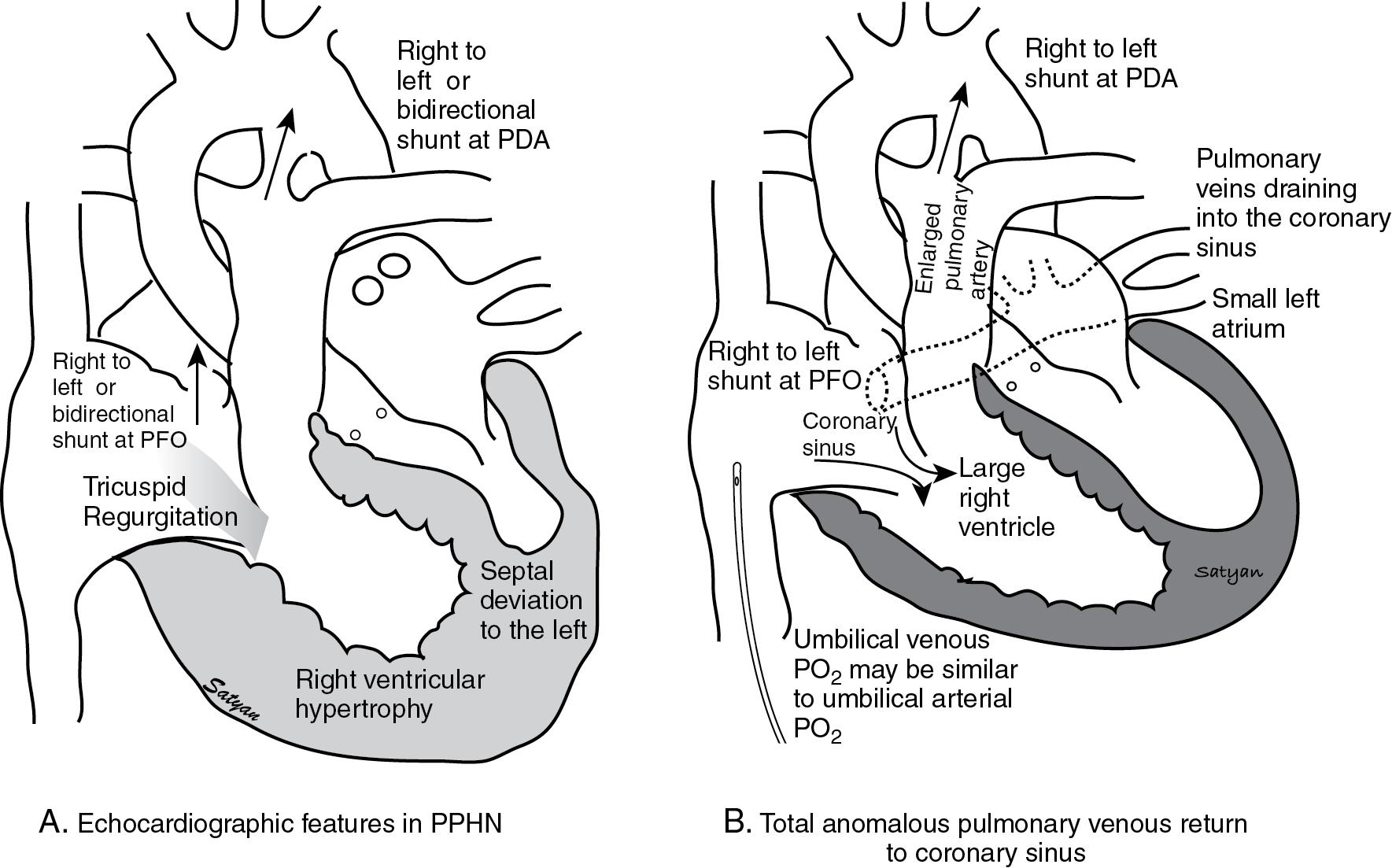Fig. 17.11, (A) Echocardiographic features of PPHN. Infants with significant PPHN often have a right-to-left or bidirectional shunt at the level of the patent foramen ovale (PFO) and/or patent ductus arteriosus (PDA). Tricuspid regurgitation (TR) jet is often noted and is used to estimated right ventricular systolic pressure. Right ventricular hypertrophy with deviation of interventricular septum to the left is commonly present. (B) Cardiac findings in total anomalous pulmonary venous return (TAPVR) to the coronary sinus. Left atrium is small and pulmonary venous flow is diverted to the right atrium. The left atrium is filled by a right-to-left shunt across the PFO. The right ventricle and pulmonary artery are enlarged because of increased blood flow. Pulmonary arterial blood flows right to left across the PDA to the aorta. If the tip of the umbilical venous catheter is in the right atrium, P o 2 levels might be relatively high—similar to umbilical arterial sample—as oxygenated blood enters the right atrium.