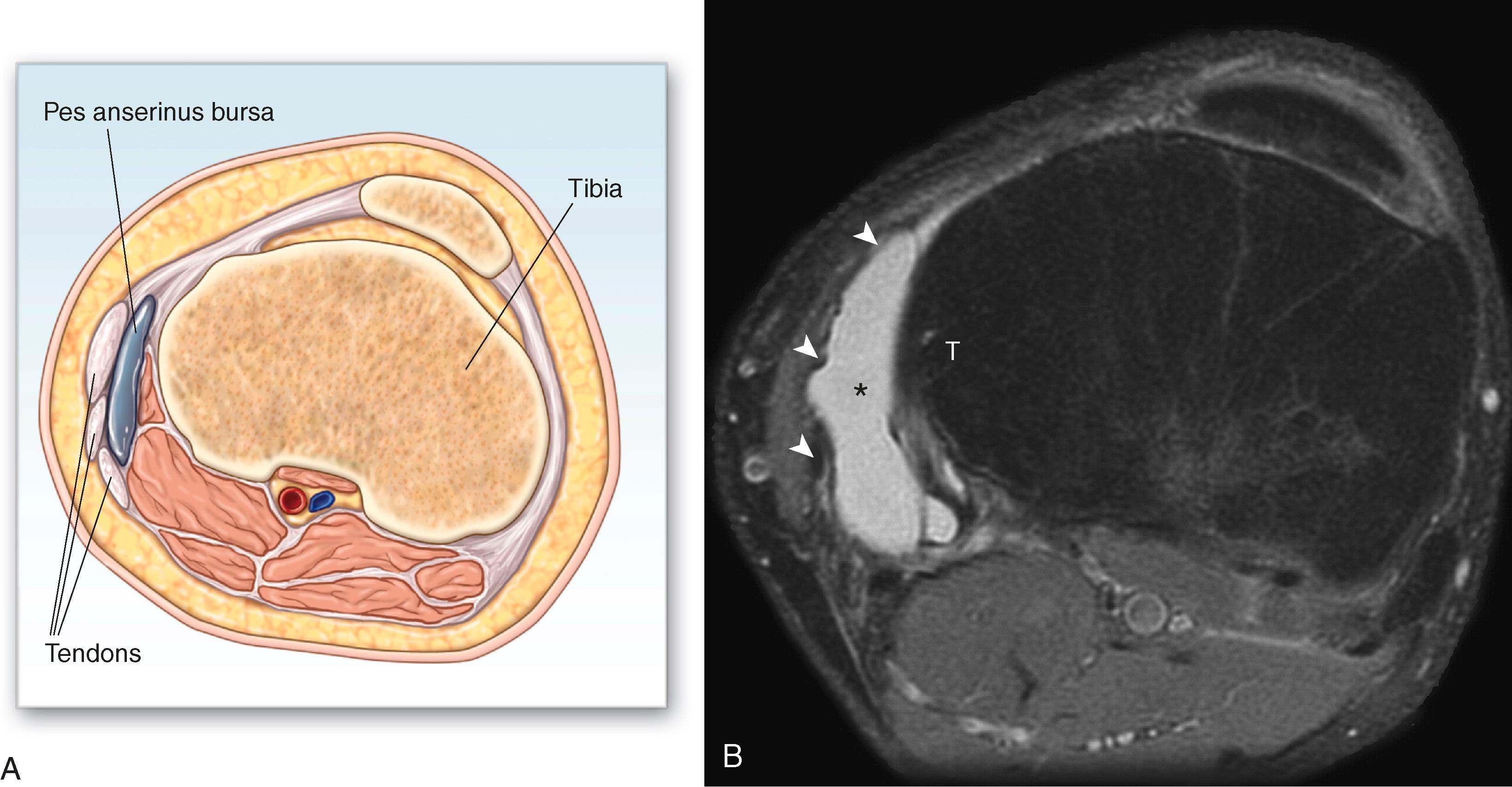 FIG. 161.1, A, Drawing of pes anserinus bursitis. This axial view shows the pes anserinus bursa (blue) located between the medial aspect of the tibia and the tendons forming the pes anserinus (from anterior to posterior: sartorius, gracilis, and semitendinosus). B, Axial proton density-weighted image with fat suppression shows a fluid collection (asterisk) located between the pes anserinus (arrowheads) and the surface of the medial tibial condyle (T), consistent with pes anserinus bursitis.