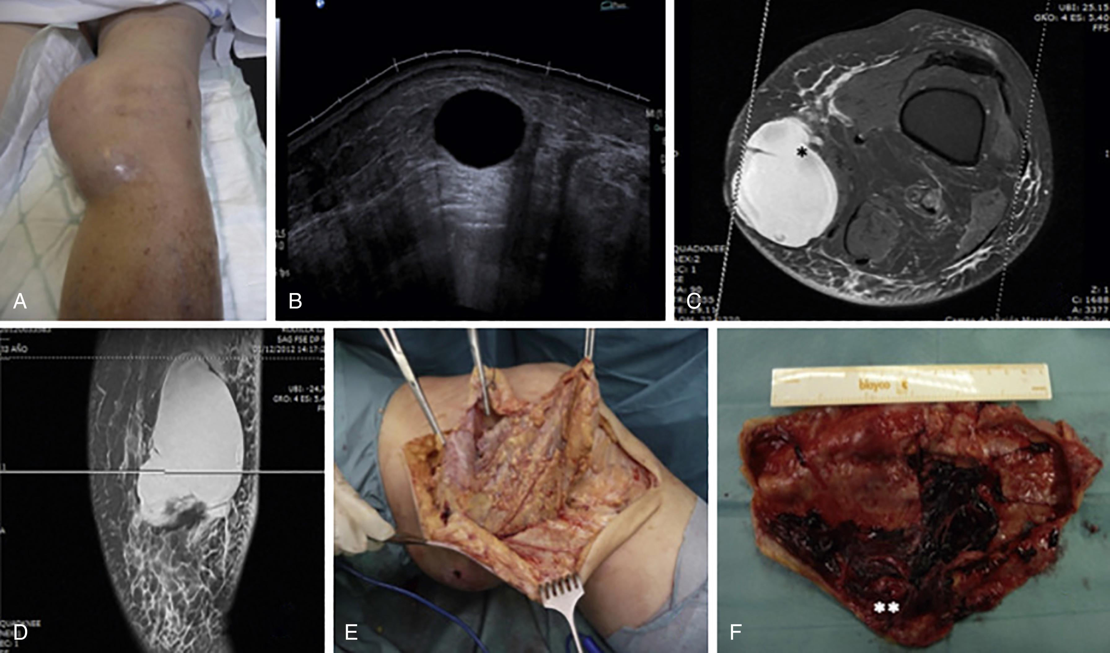 FIG. 161.3, (A) Clinical aspect of the soft-tissue mass in the medial knee, (B) gray-scale ultrasound showing a 16-cm long, well-defined anechoic mass (area: >15.6 cm 2 ) without synovial hypertrophy in the pes anserinus bursa, (C) magnetic resonance imaging with axial T1 view showed a homogeneous soft-tissue mass at the enthesis of pes anserinus conjoint tendon with peripheral enhancement (∗). Absence of hemosiderin deposits and no evidence of bone or joint involvement, (D) T1 coronal view of the bursa, (E) intraoperative image of the lesion showed multiple yellow to brown nodules inside the pes anserinus bursa, (F) 15-cm large bursa excision pathology confirmed the pathology (∗∗).