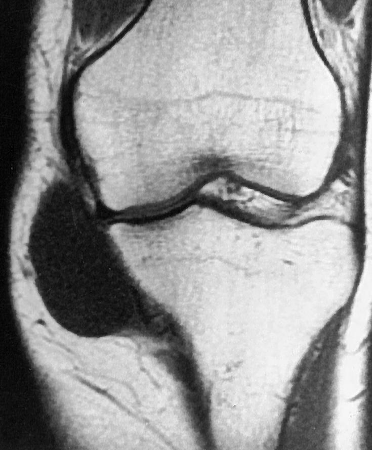 FIG. 161.4, Pes anserinus ganglion cyst (bursitis). Magnetic resonance image shows a large, fluid-filled mass adjacent to the anteromedial portion of the tibia.